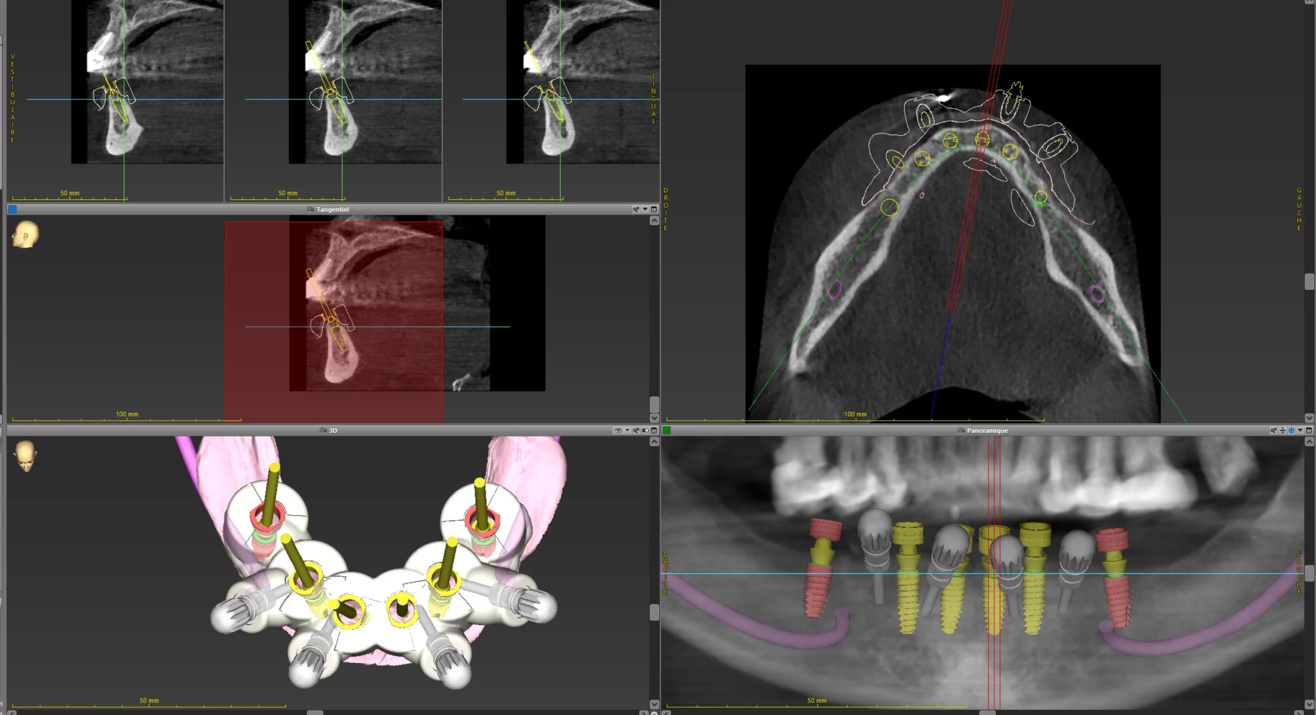 Images d’implants dentaires