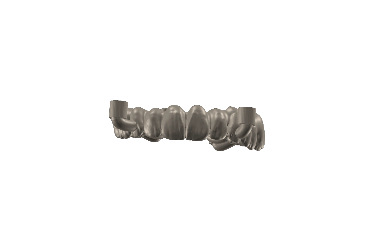Fusion des données CBCT et de l’empreinte optique pour la planification du traitement