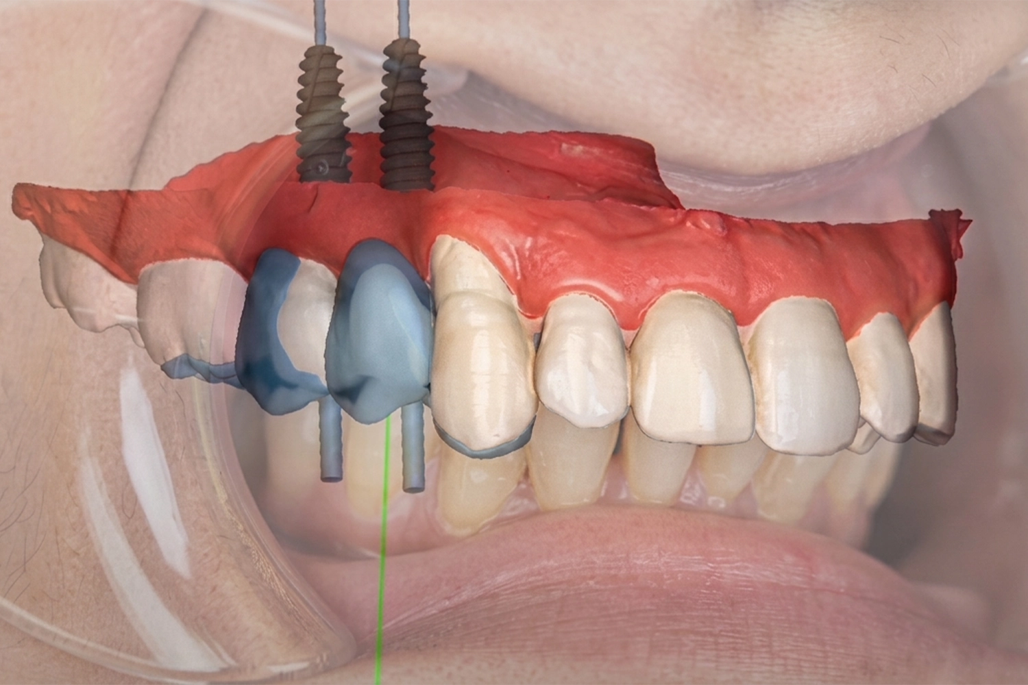 Position d’implant planifiée virtuellement sur un modèle 3D de la mâchoire