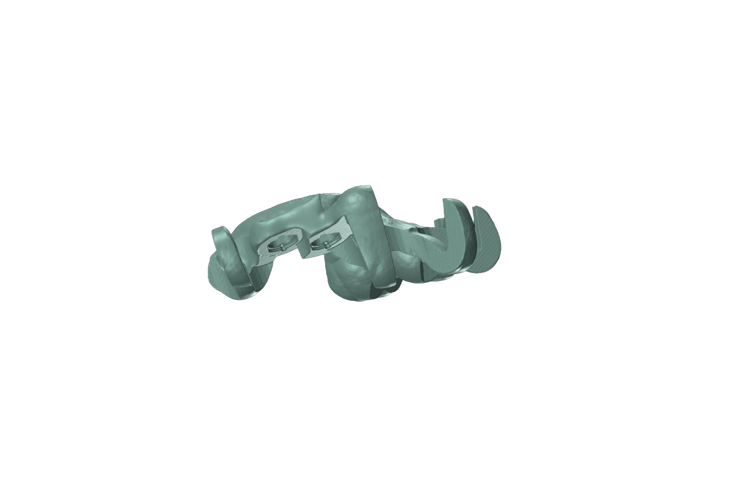 Guide chirurgical vérifié par rapport à l’axe d’implant planifié