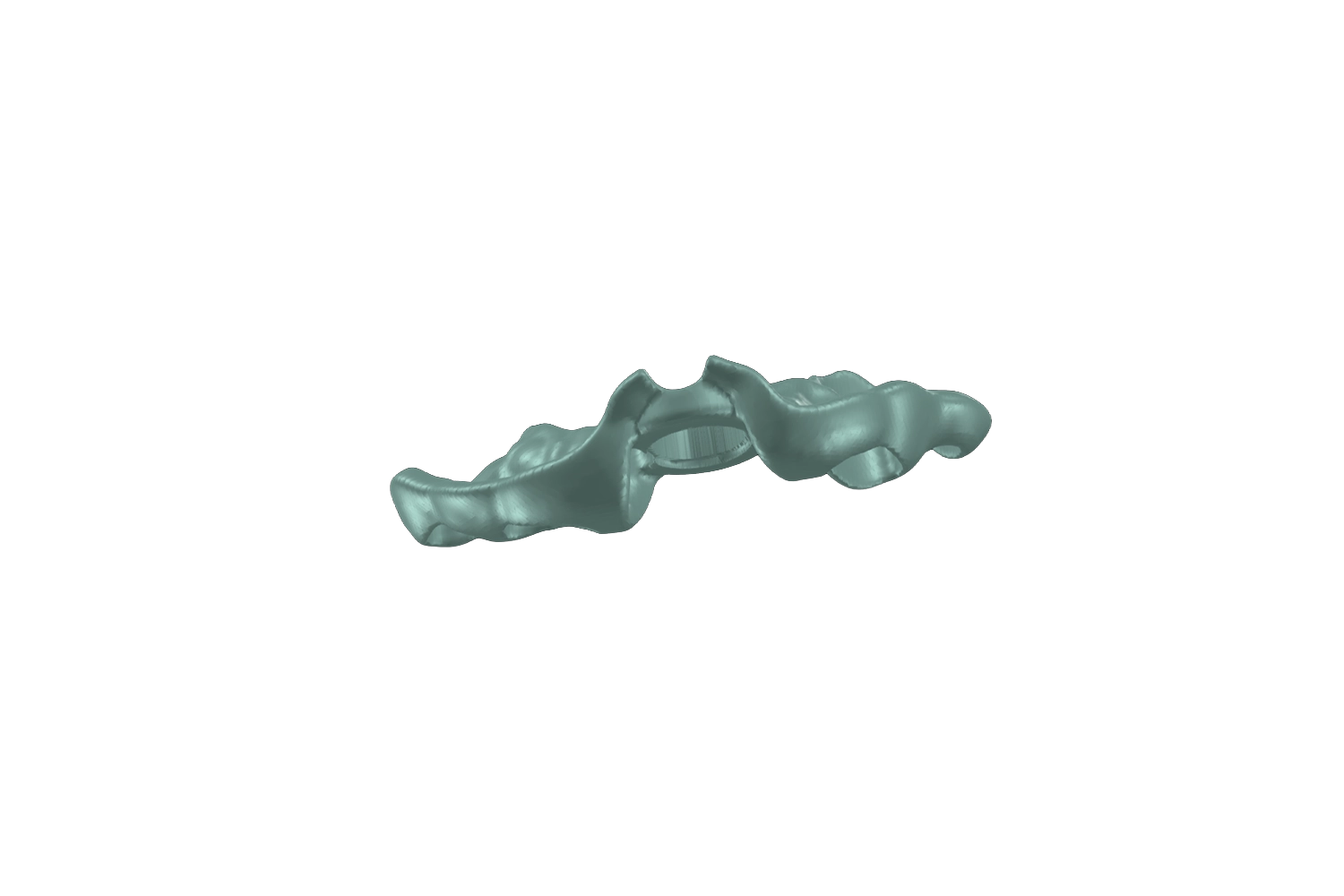 Guide chirurgical en position au début de la pose de l’implant