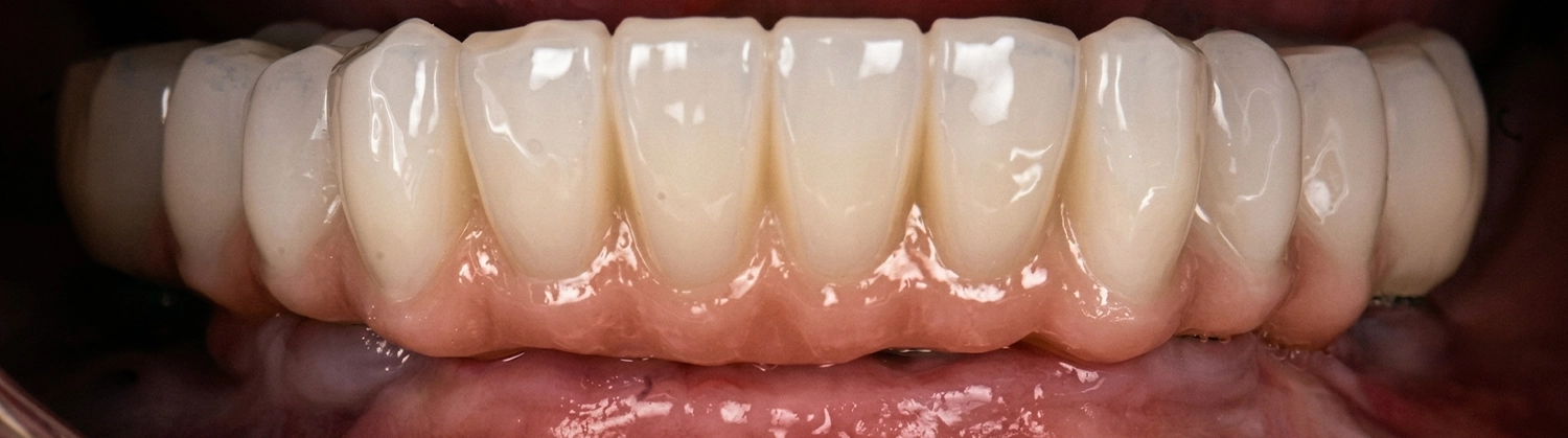 Prothèse sur implants, après traitement