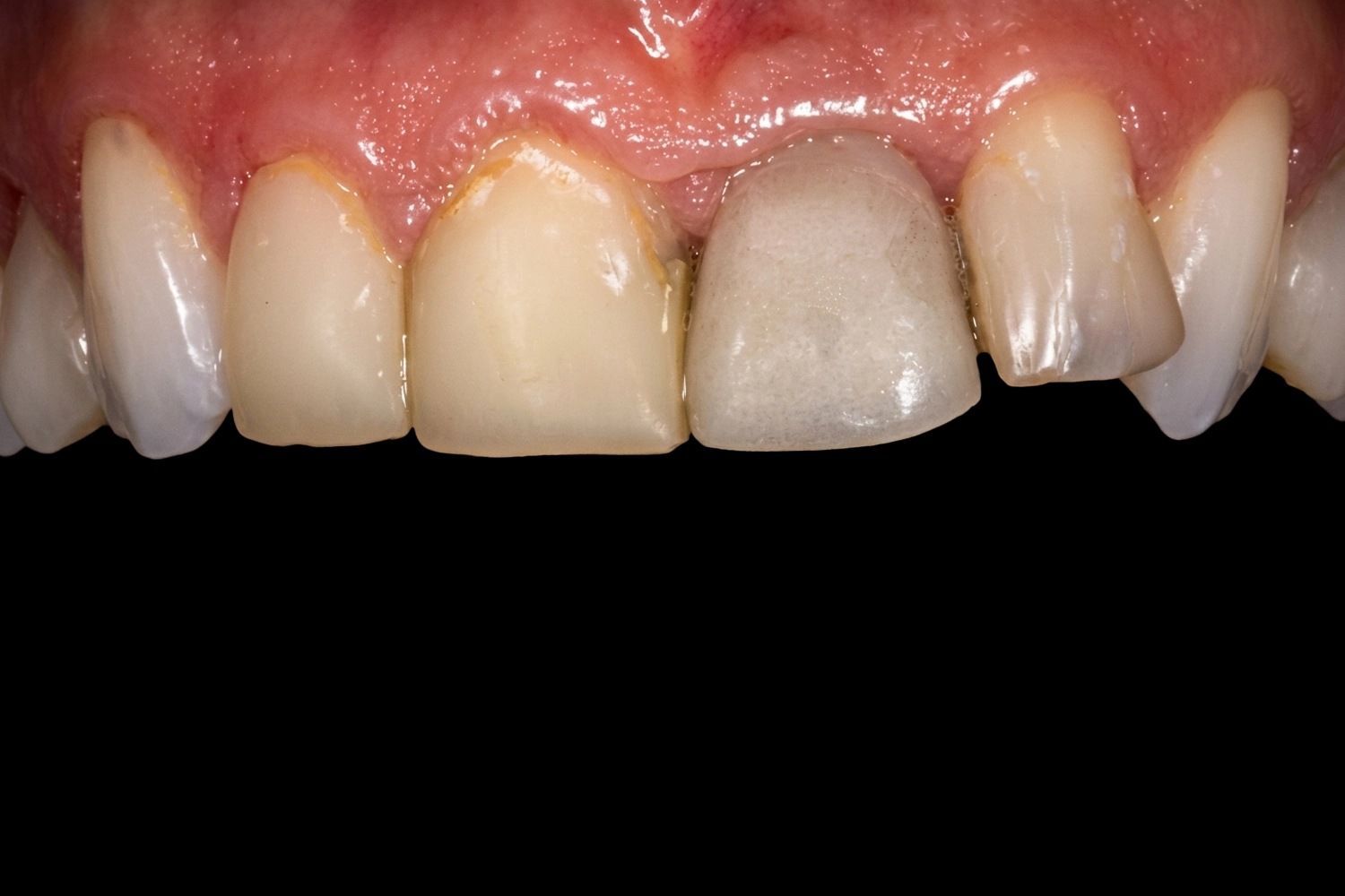 Implant unitaire, avant traitement